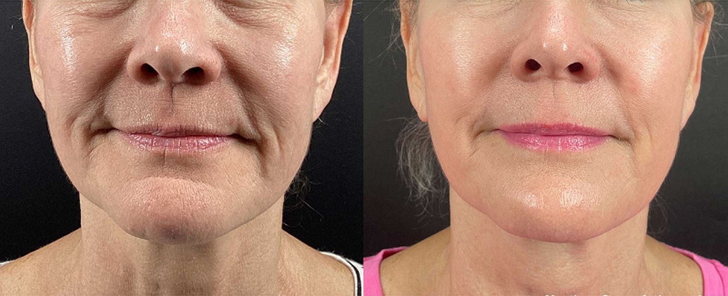 Before and after facial treatment comparison.