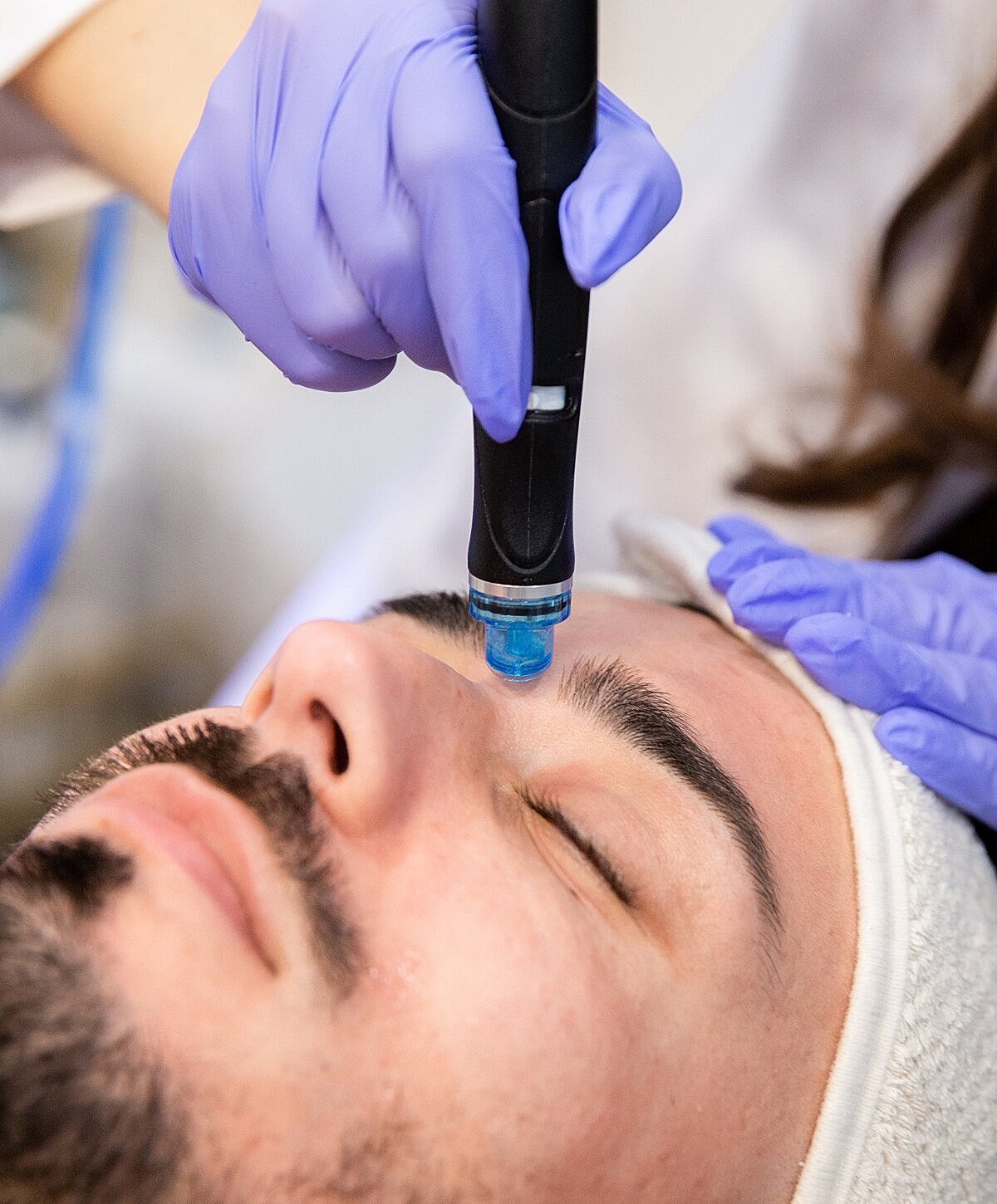Facial treatment with microneedling device in progress