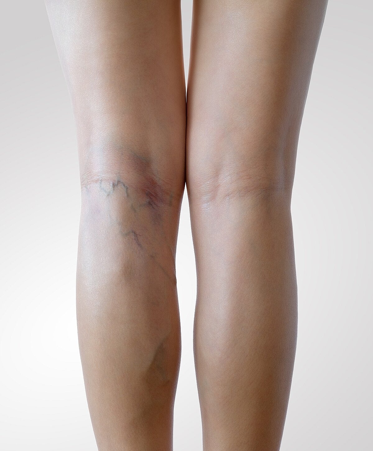 Legs with visible bruising and discoloration.