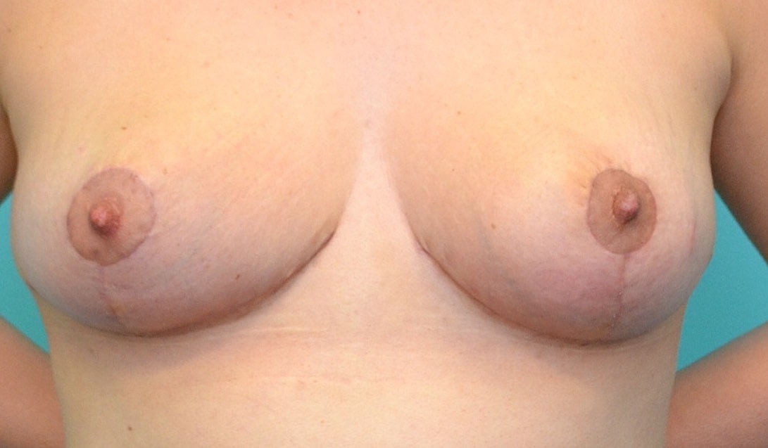 Breast Lift Before & After