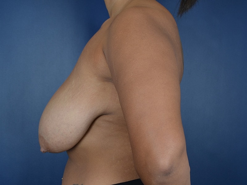 Breast Lift Before & After