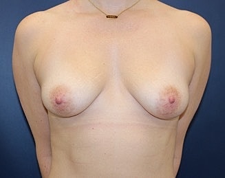 Breast Lift Before & After