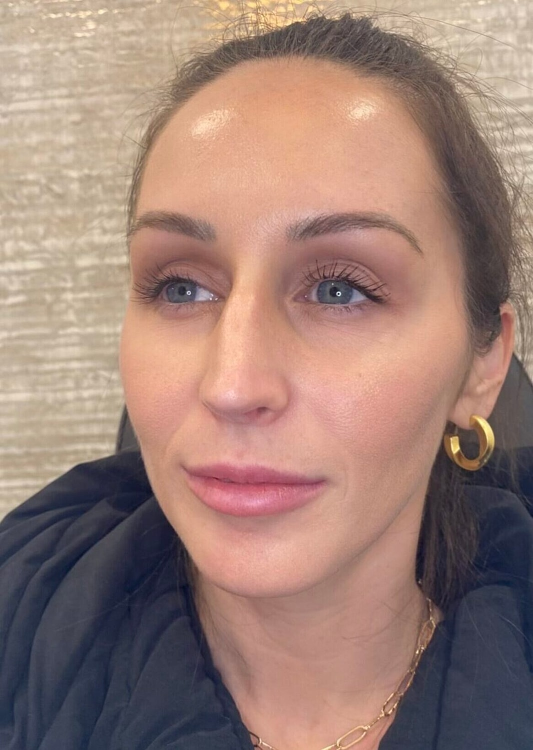 Sculptra Before & After