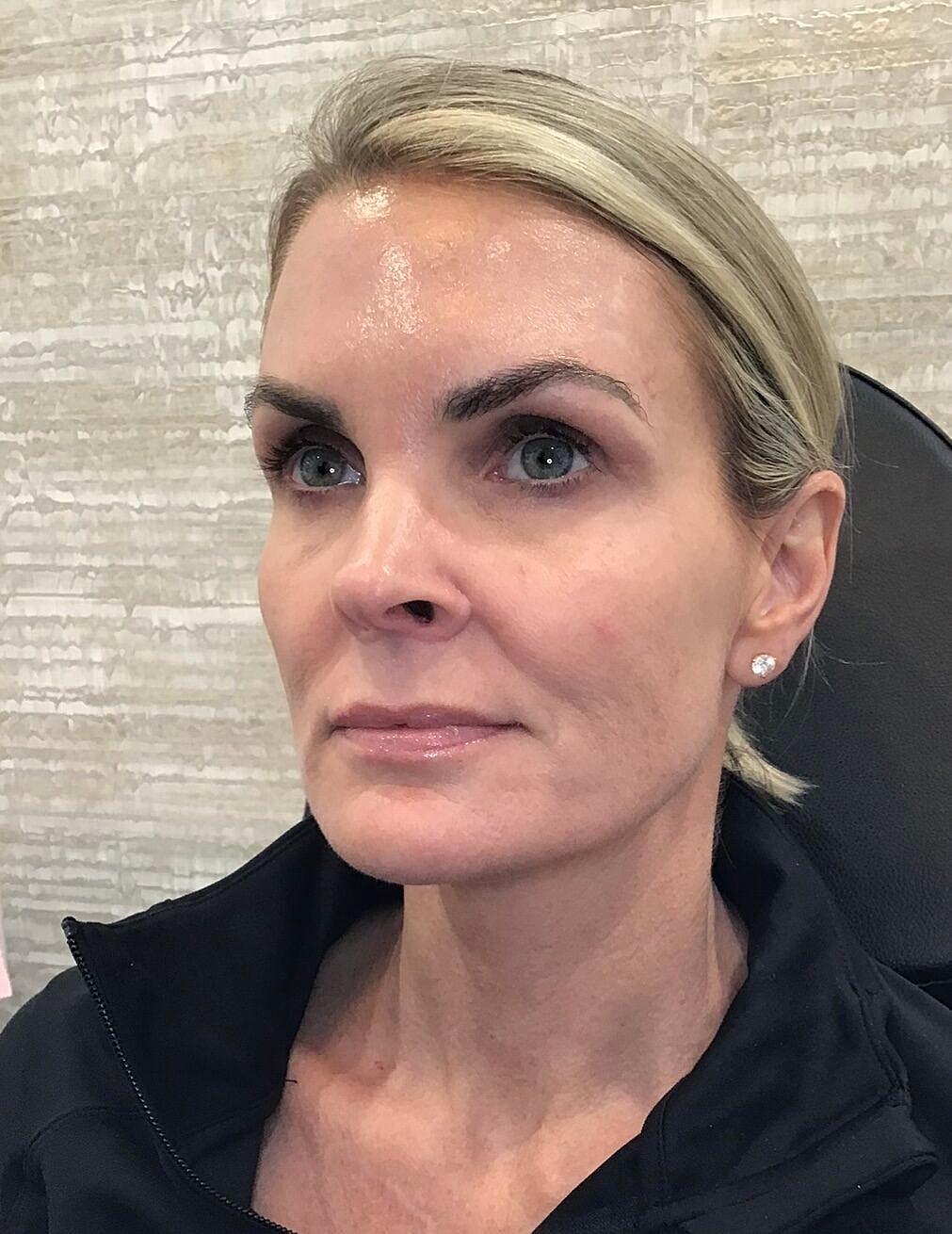 Sculptra Before & After