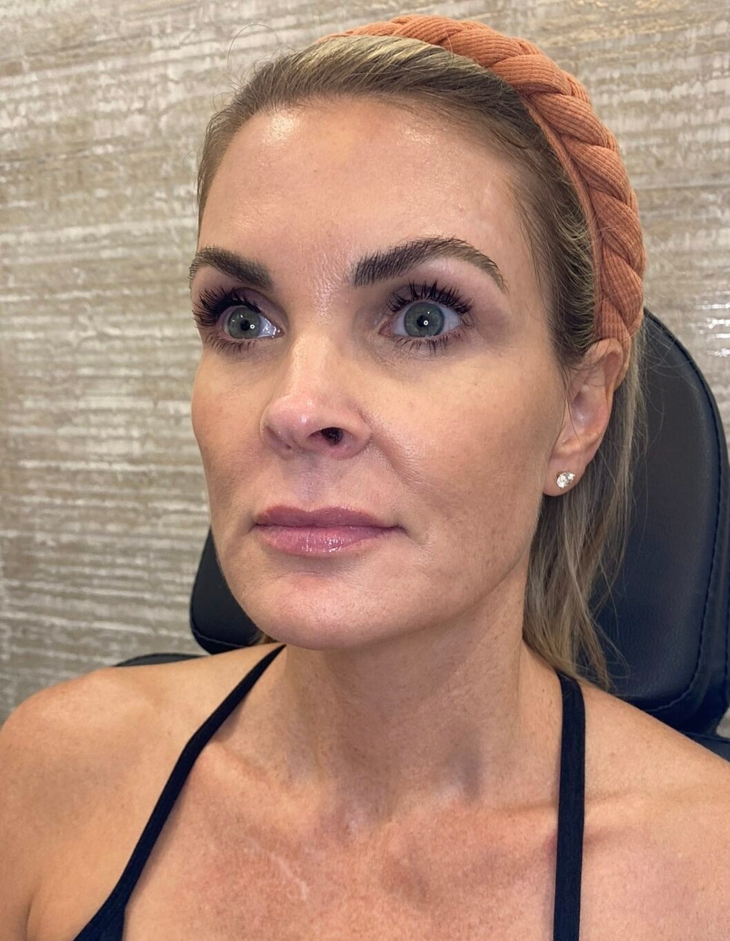 Sculptra Before & After
