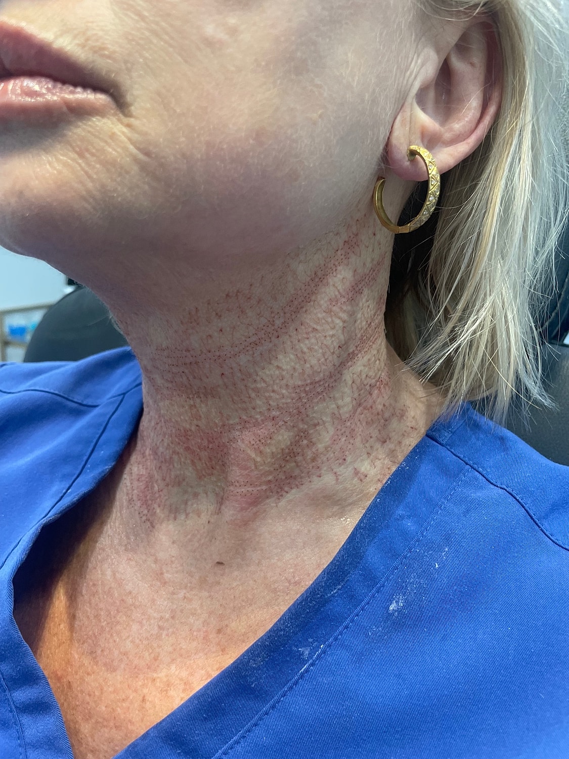 Skin Tightening Before & After