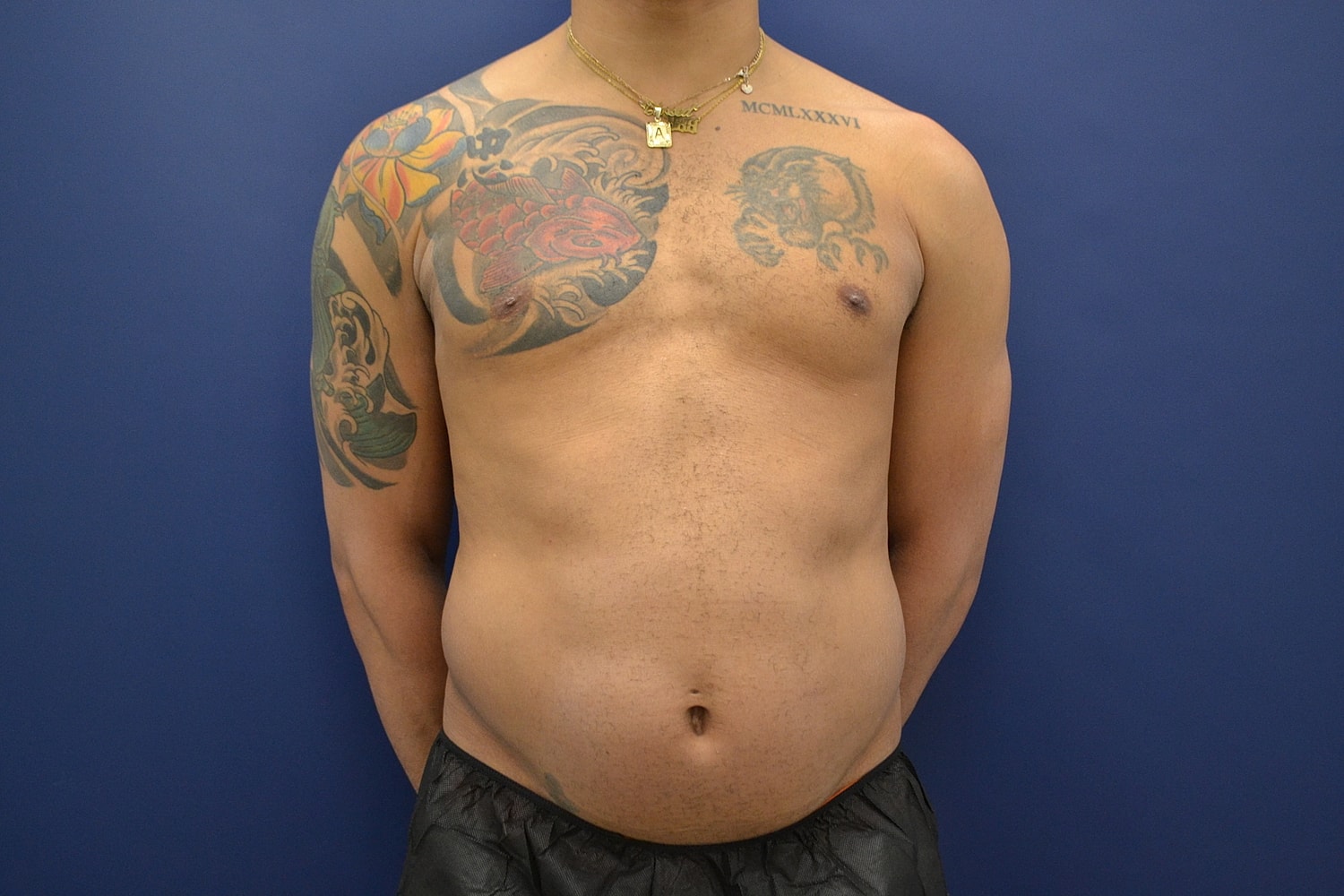 Skin Tightening Before & After