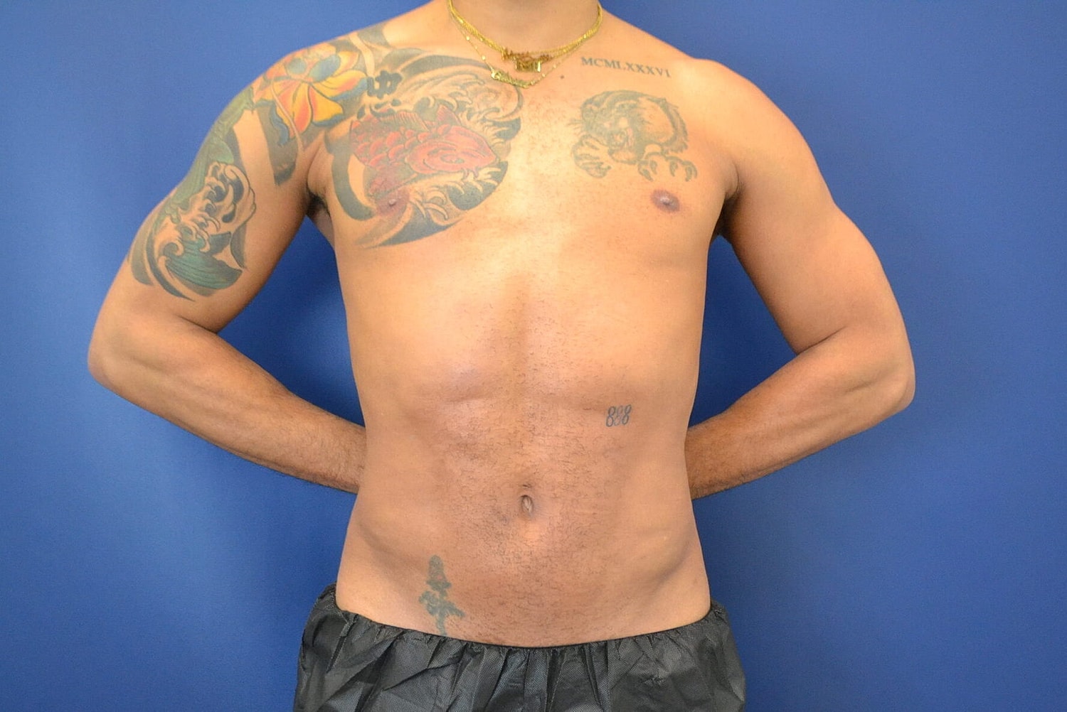 Skin Tightening Before & After