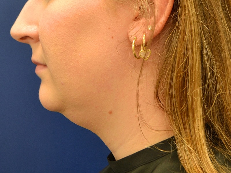 Skin Tightening Before & After