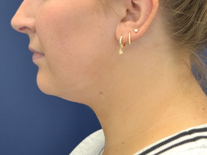 Skin Tightening Before & After