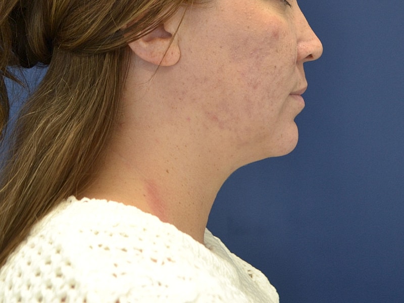 Skin Tightening Before & After
