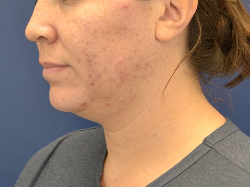 Skin Tightening Before & After