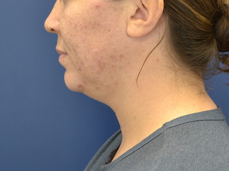 Skin Tightening Before & After