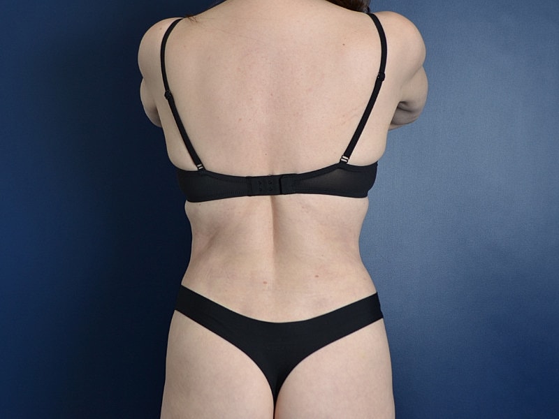 Skin Tightening Before & After