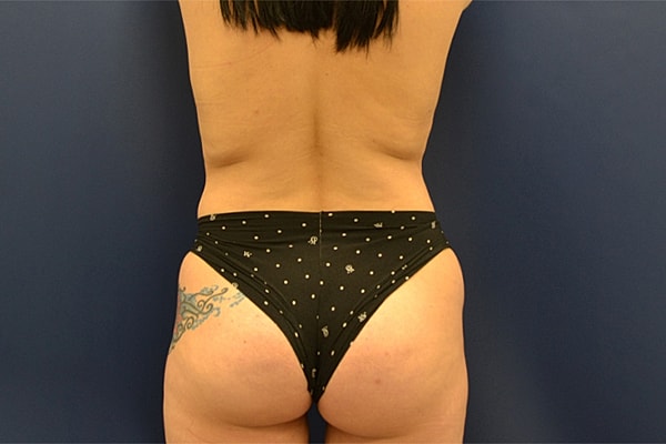 Brazilian Butt Lift Before & After