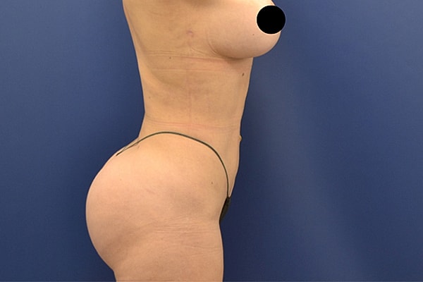 Brazilian Butt Lift Before & After