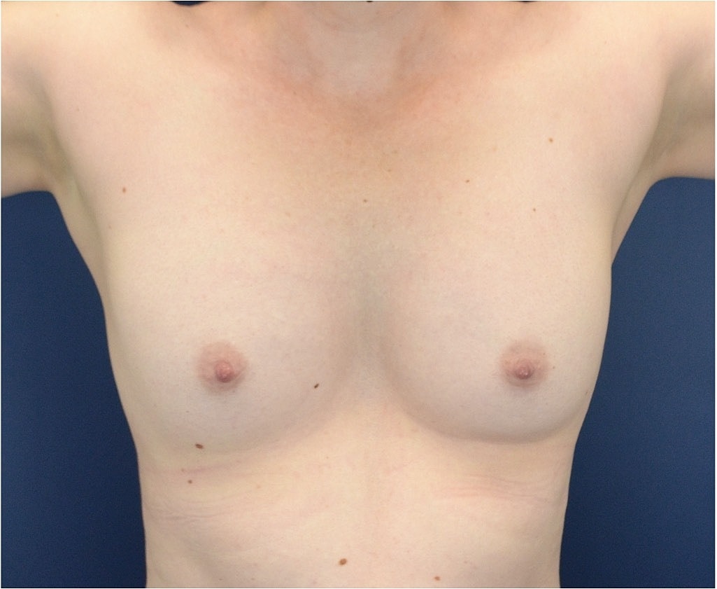 Breast Augmentation Before & After