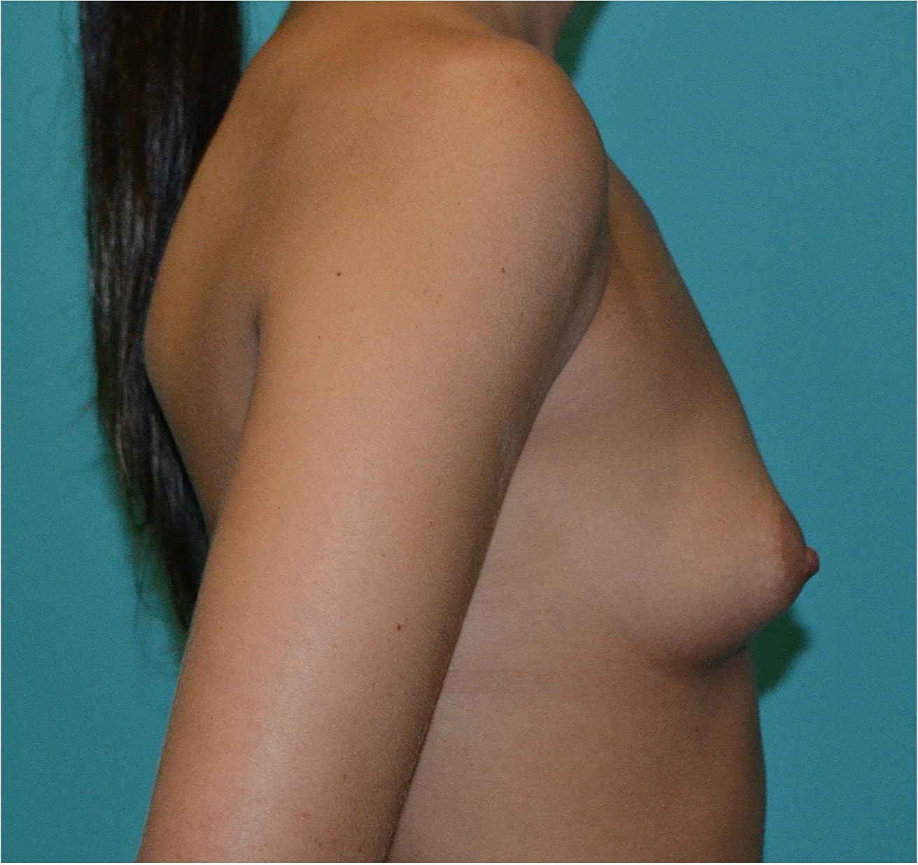 Breast Augmentation Before & After