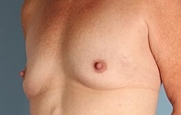 Breast Augmentation Before & After