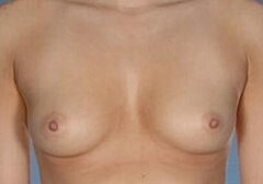 Breast Augmentation Before & After