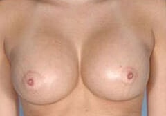 Breast Augmentation Before & After