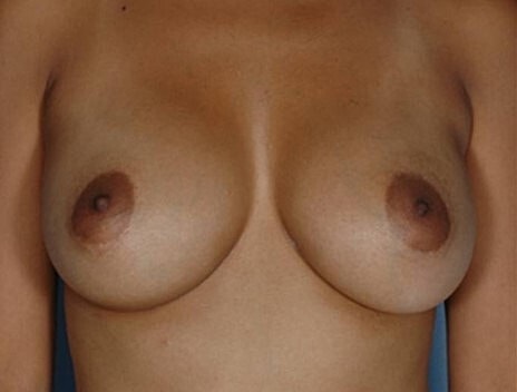 Breast Augmentation Before & After