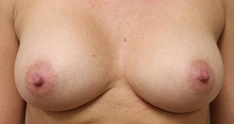 Breast Augmentation Before & After