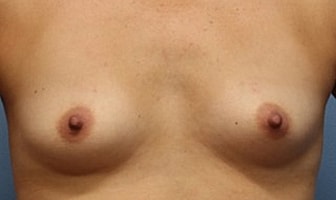 Breast Augmentation Before & After