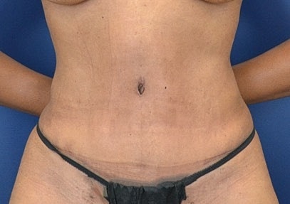 Tummy Tuck Before & After