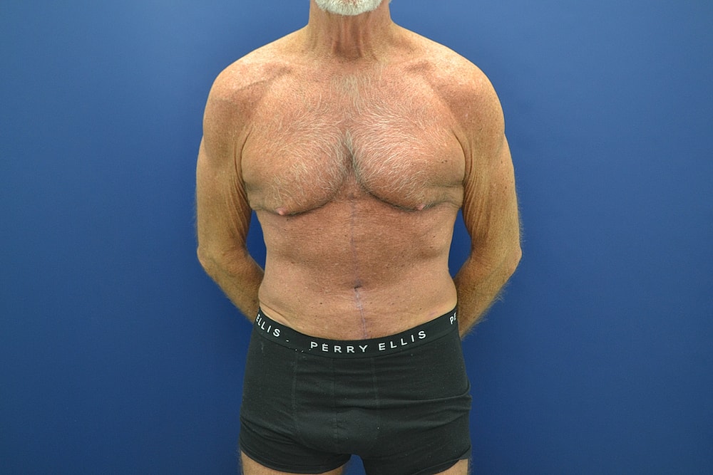 Tummy Tuck Before & After