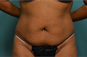 Tummy Tuck Before & After