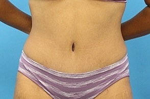 Tummy Tuck Before & After