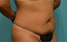 Tummy Tuck Before & After