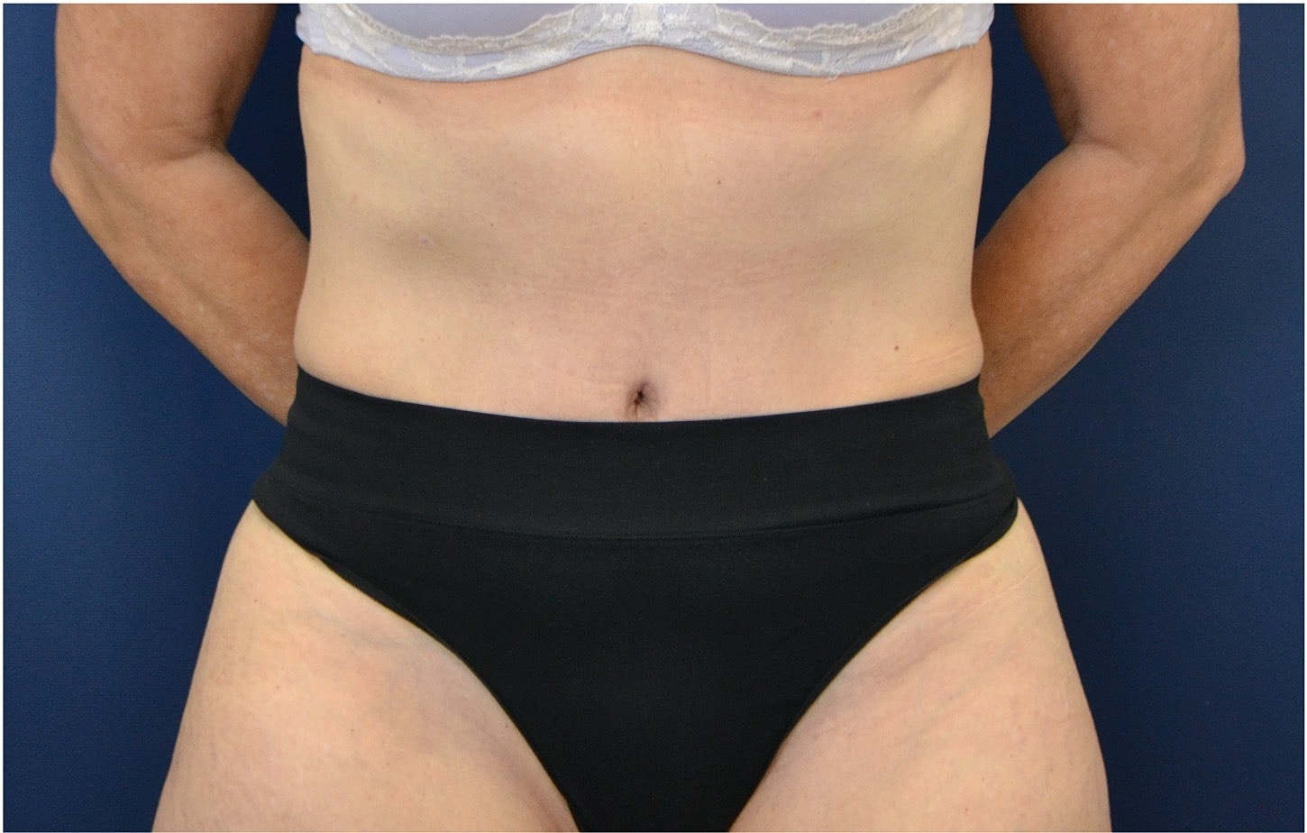 Tummy Tuck Before & After