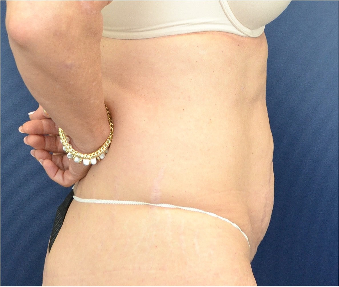 Tummy Tuck Before & After