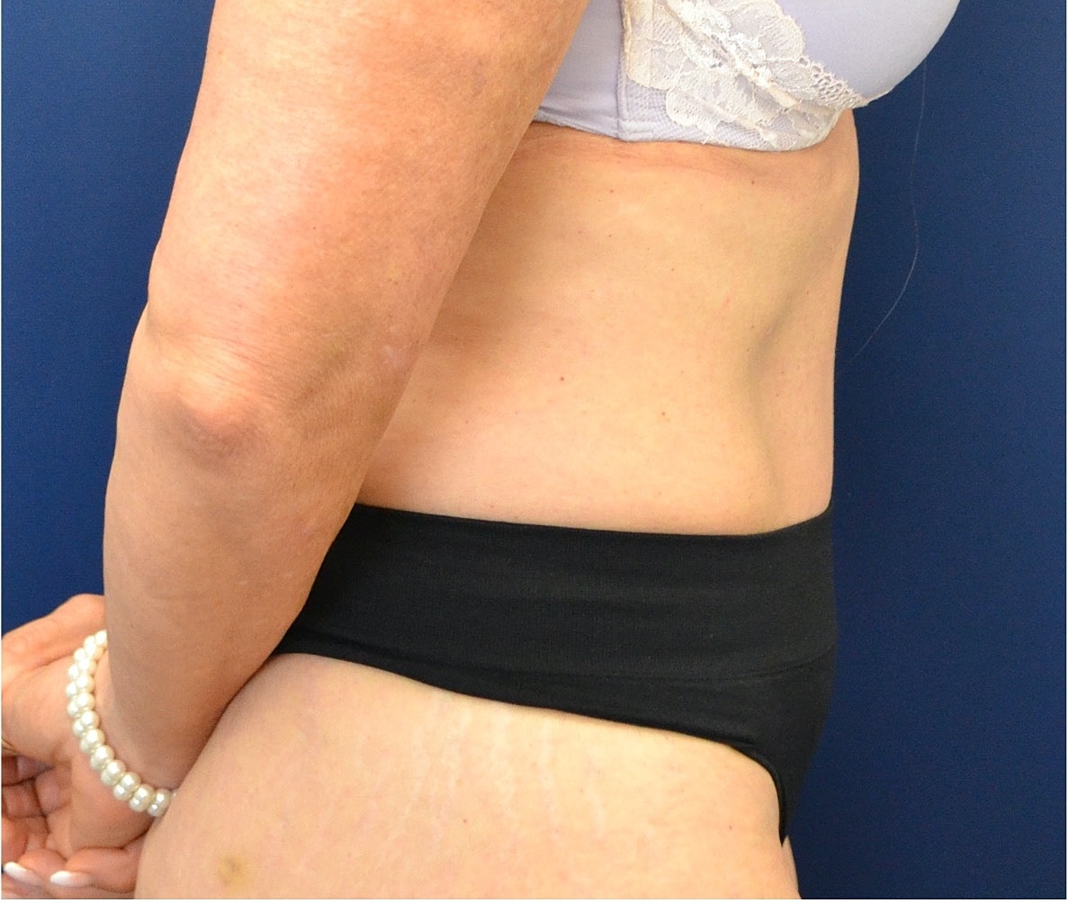 Tummy Tuck Before & After