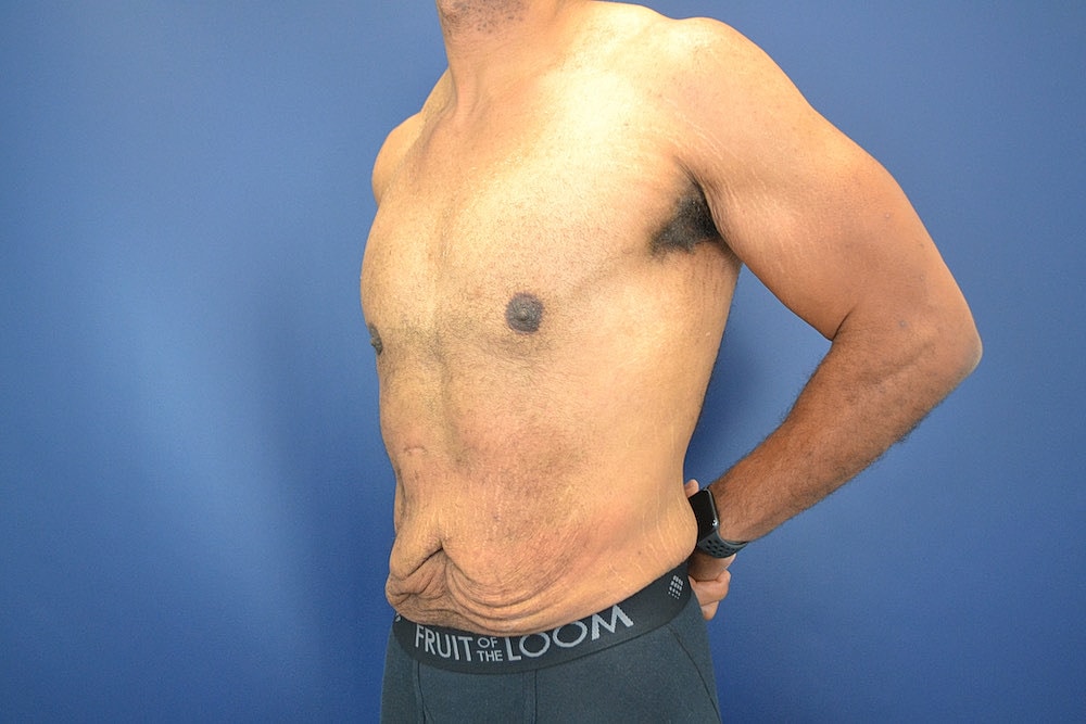 Tummy Tuck Before & After