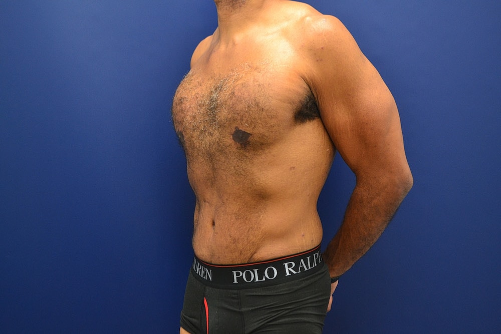 Tummy Tuck Before & After