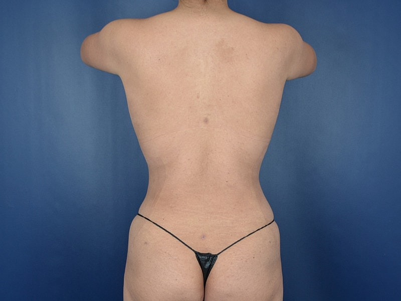Liposuction Before & After