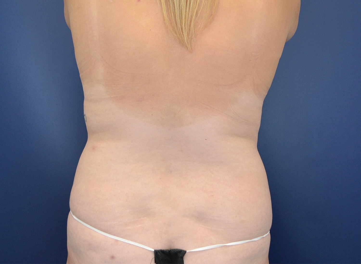 Liposuction Before & After