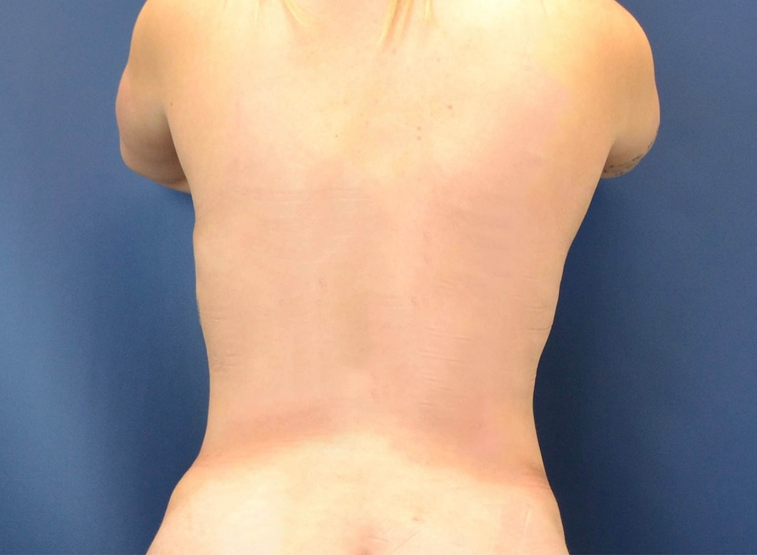 Liposuction Before & After