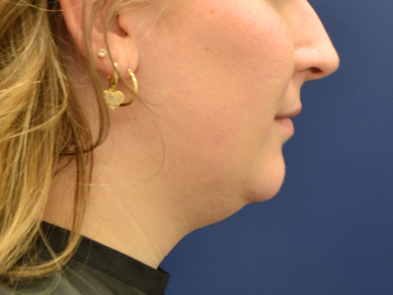 Liposuction Before & After