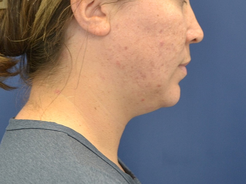 Liposuction Before & After