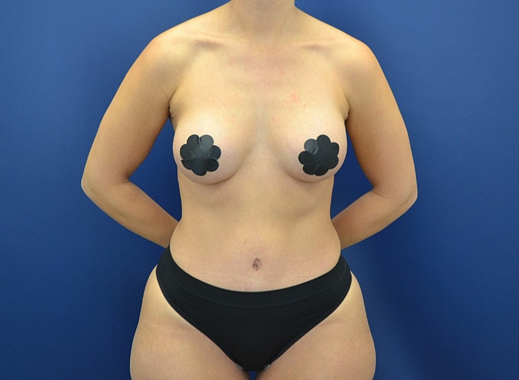 Liposuction Before & After