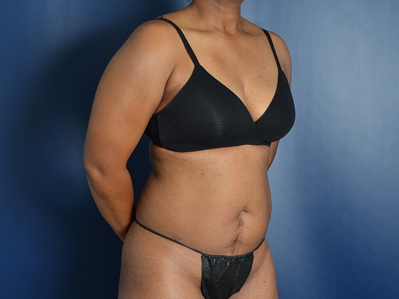 Liposuction Before & After