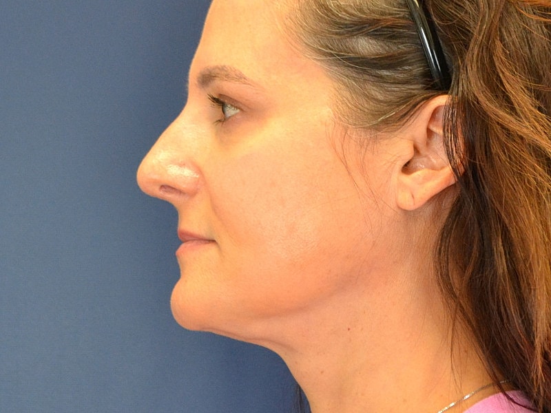 Liposuction Before & After