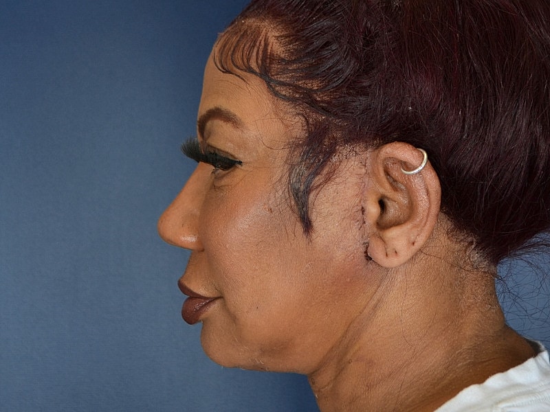 Liposuction Before & After