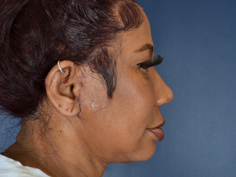 Liposuction Before & After