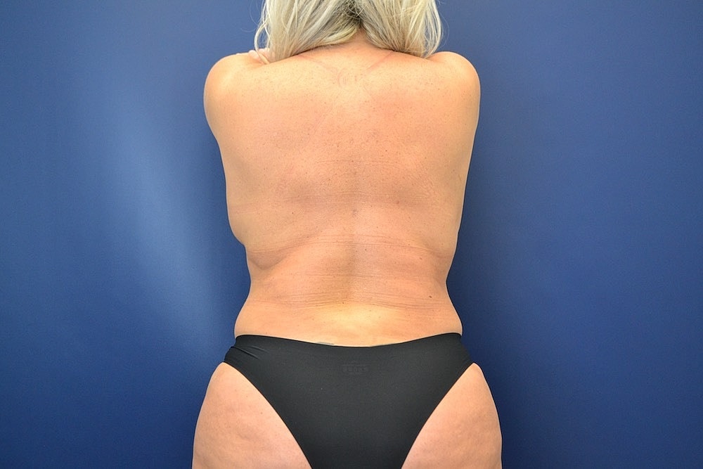 Liposuction Before & After