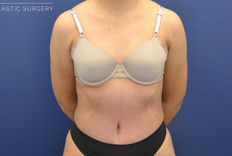 Liposuction Before & After